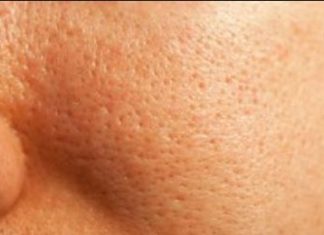 The Anemia Will Disappear And You Will Have Skin Without Large Pores Using Quince