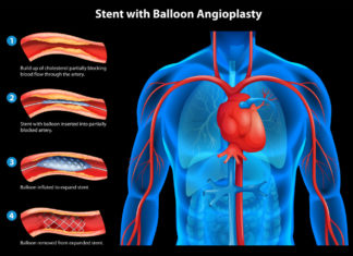 Clotting of the heart stent – is it possible?
