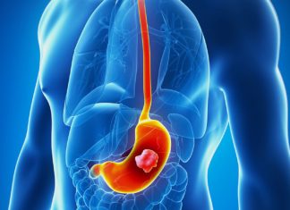 The Scientist Found That This Vitamin Prevents The Risk Of Stomach Cancer