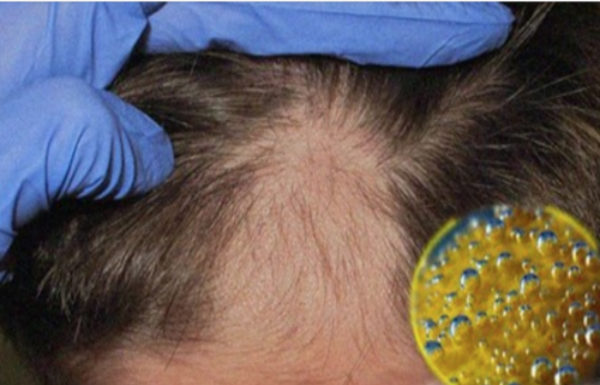 Three Spoonfuls a Day and You Will Recover Your Hair Lost by Baldness; Starts Today