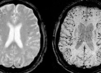 3 Mineral Waters That Can Remove Aluminum from the Brain