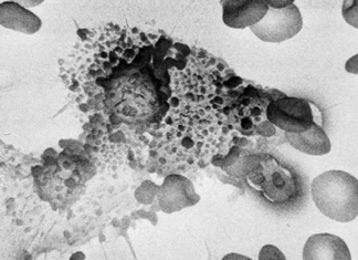 How To Starve Cancer To Death By Removing One Thing From Your Diet