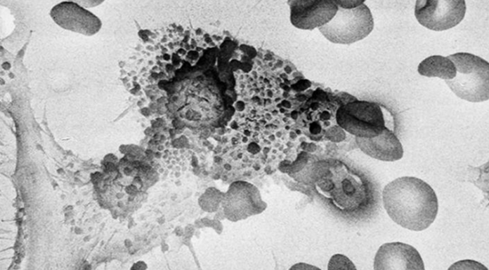 How To Starve Cancer To Death By Removing One Thing From Your Diet