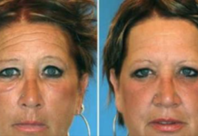 What? Smoker Vs. Non-Smoker Identical Twins Look Like After Years of Smoking
