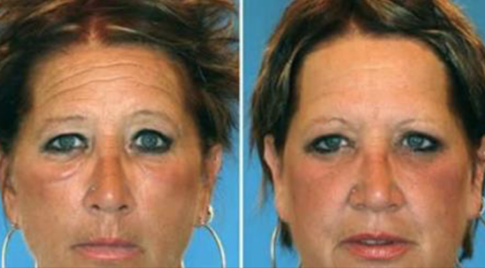 What? Smoker Vs. Non-Smoker Identical Twins Look Like After Years of Smoking
